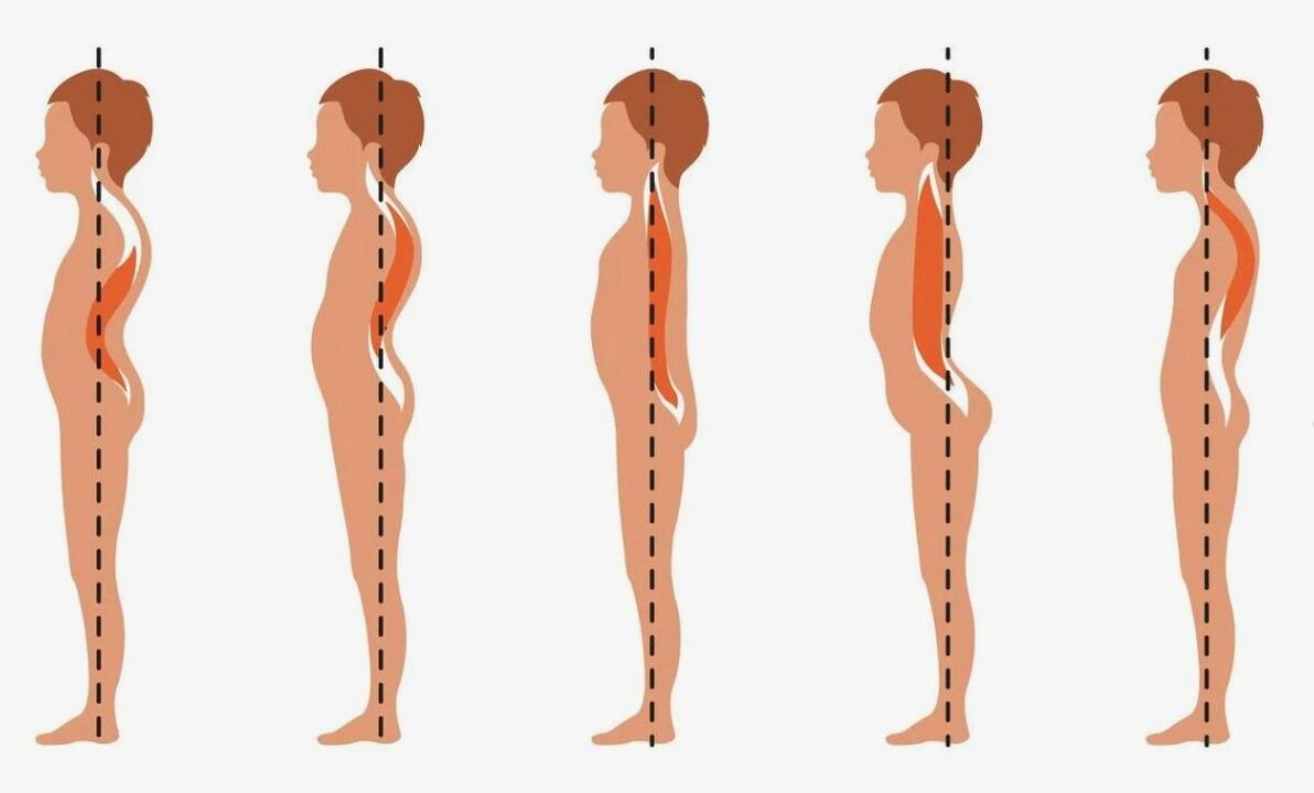 Grado de desarrollo de la osteocondrosis lumbar. 