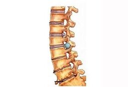 Etapas de desarrollo de la osteocondrosis del cuello uterino