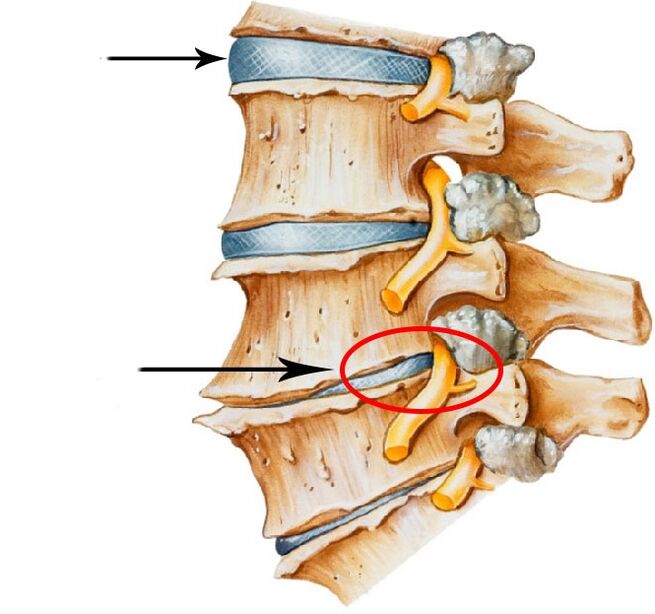Desarrollo de hernia de disco duro