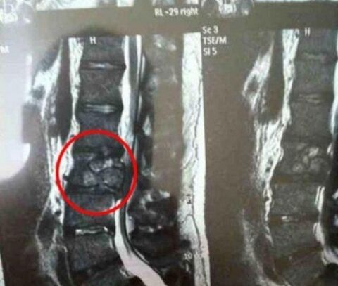 El tumor de sala vertebral en la imagen