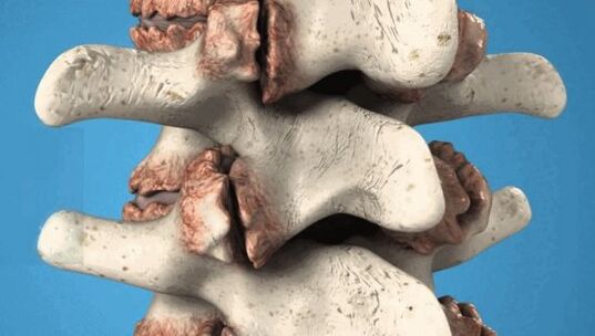 Osteophitos de las vértebras crecimiento patológico que dañan los nervios y los vasos sanguíneos