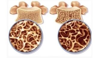 Peligro del ojo cervical para las mujeres