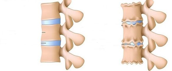 Columna sana y osteocondrosis