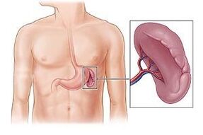 Patología del bazo como causa de dolor debajo del omóplato izquierdo.