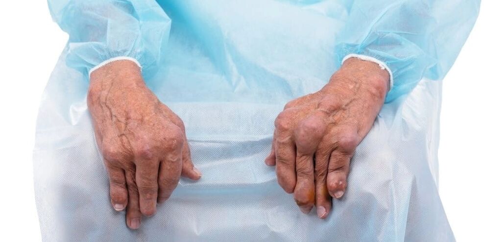 La artritis infecciosa es una enfermedad con dolor constante y cambios en las articulaciones de los dedos.